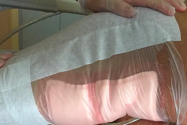 protection_pansement_etanche_absces_escarre_ulcere